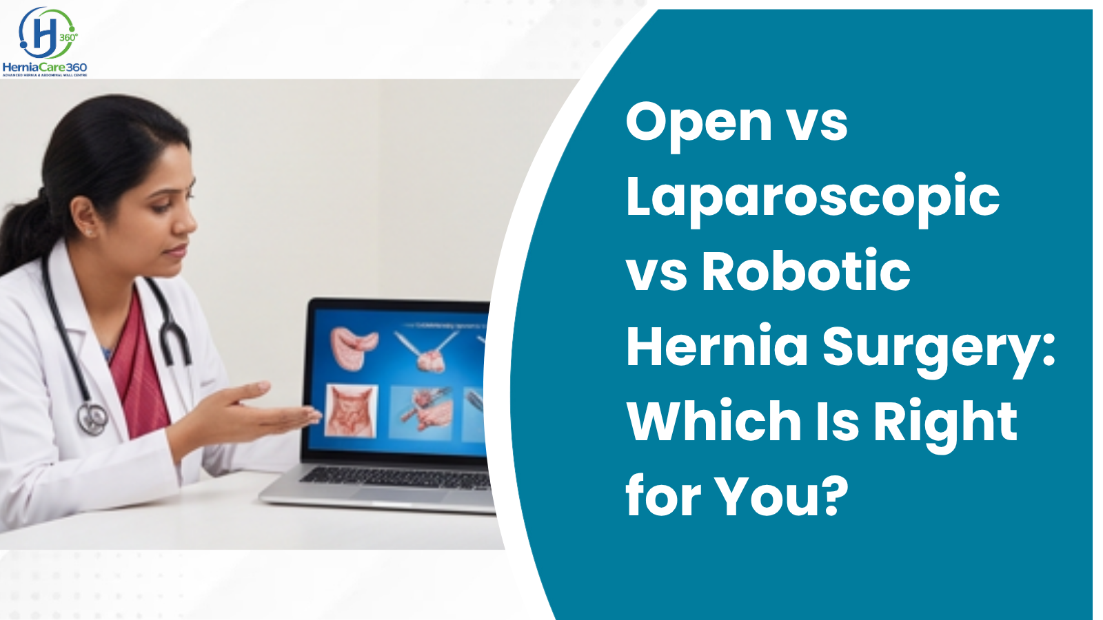 Open vs Laparoscopic vs Robotic Hernia Surgery