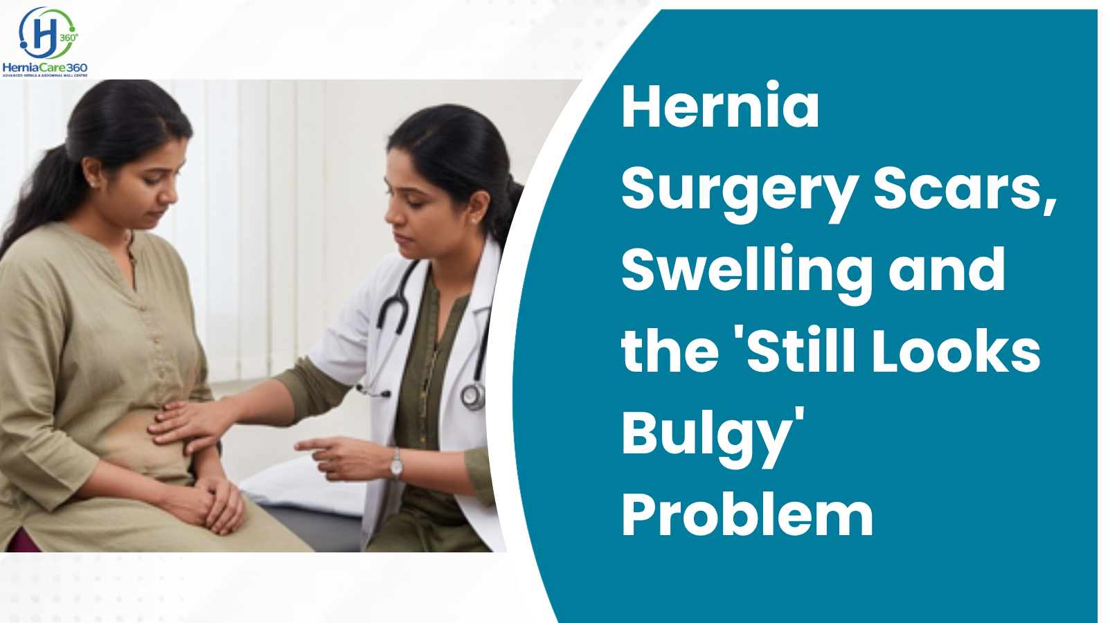 Hernia Surgery Scars, Swelling and the Still Looks Bulgy Problem