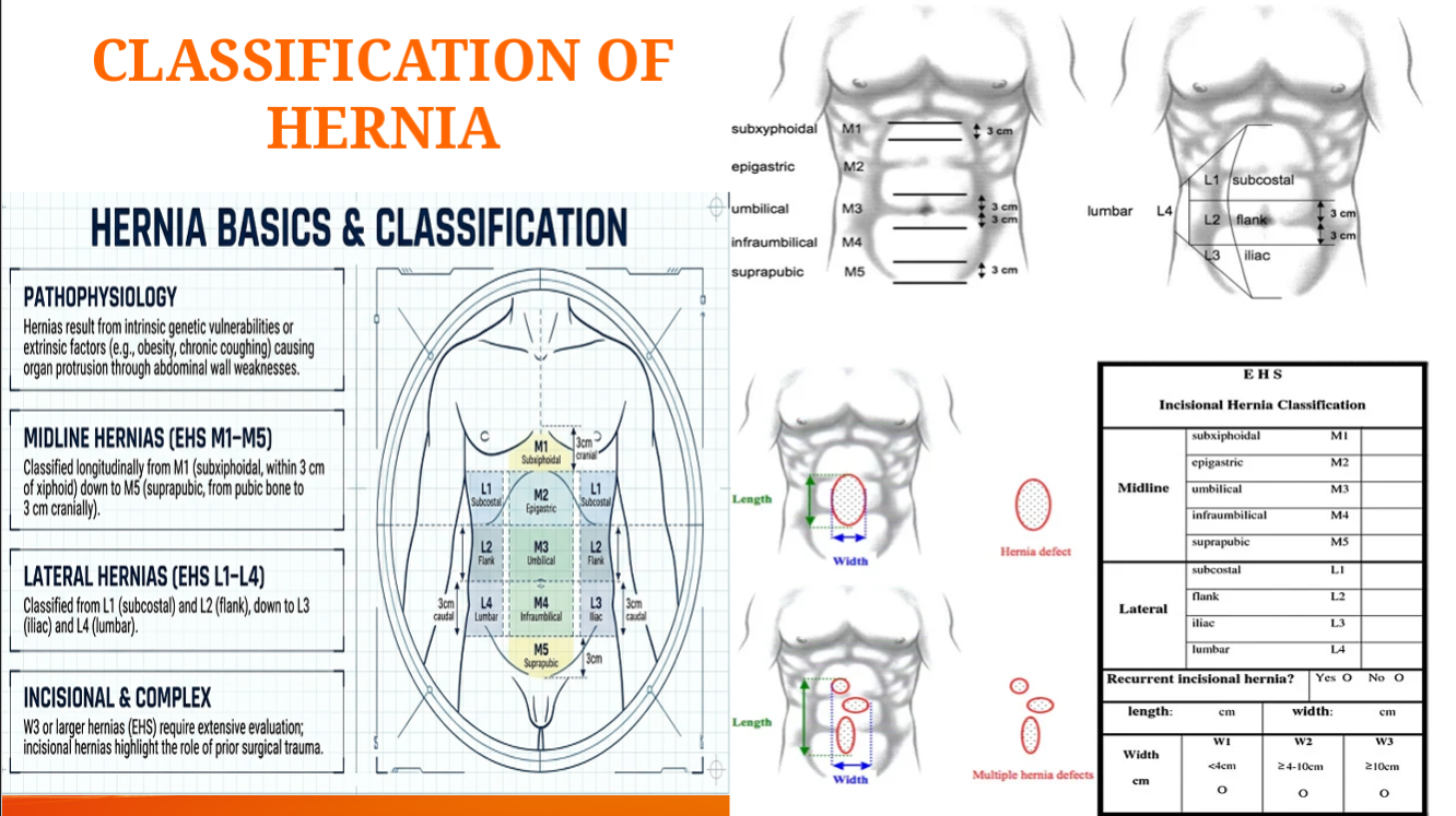 Classification of Abdominal Hernias Diagram