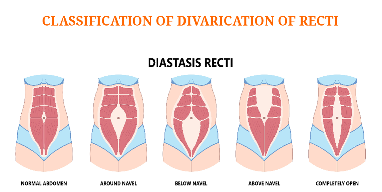 Diastasis Recti Classification Diagram