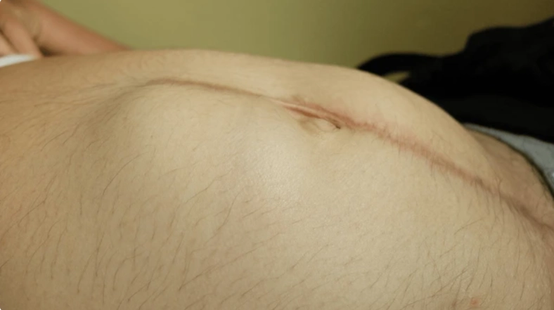 Incisional Hernia