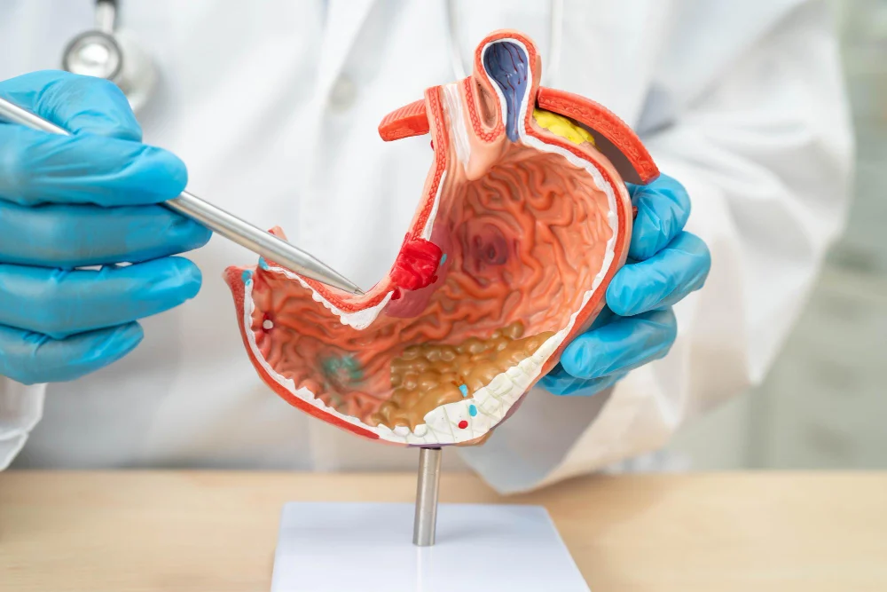 Extended Totally Extraperitoneal