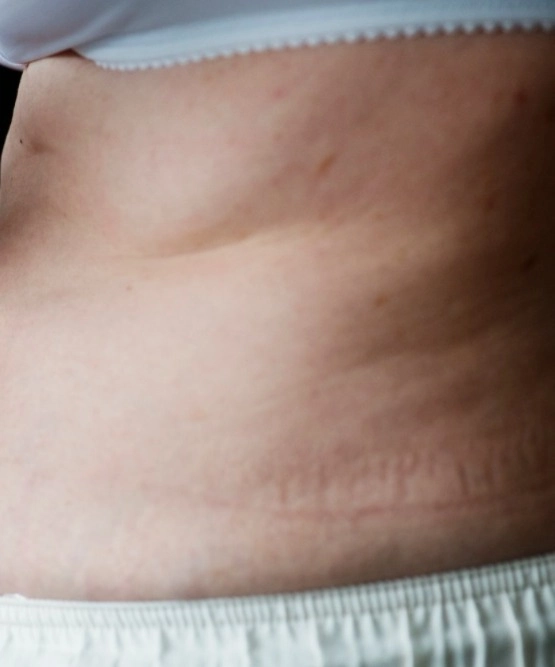 Fixing Loose Belly Skin